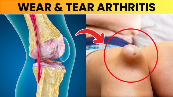 What is Wear and Tear Arthritis - Things You SHOULD Know